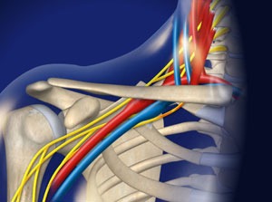 vascular ultrasound thoracic outlet syndrome arm pain cold white hand numbness tingling compression rib blood clot vein nerve