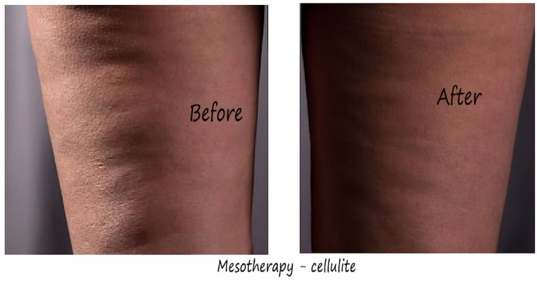 Before & after Mesotherapy Delhi – 35 yr woman with cellulite thigh, smoother skin after 1 session