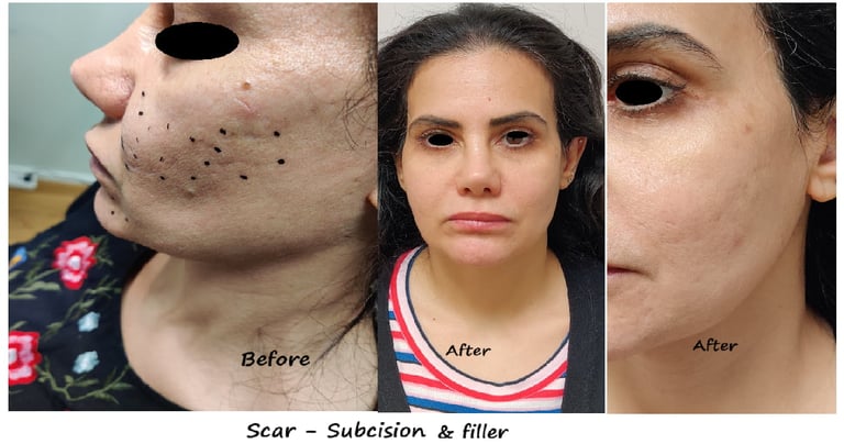 Before and after image of scar treatment – improved skin texture and smoother appearance.