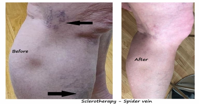 Before & after spider veins treatment Delhi – leg vein clusters reduced after sclerotherapy..