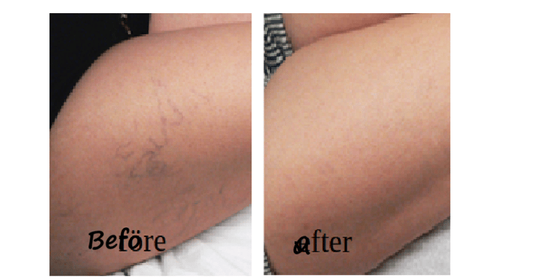 Before & after spider veins treatment Delhi – thigh veins cleared after sclerotherapy
