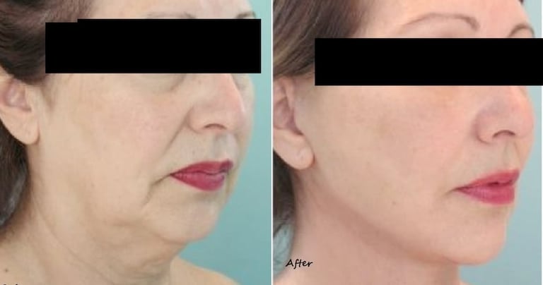 Non-surgical thread lift with fillers and fat reduction, results on 50-year-old woman.