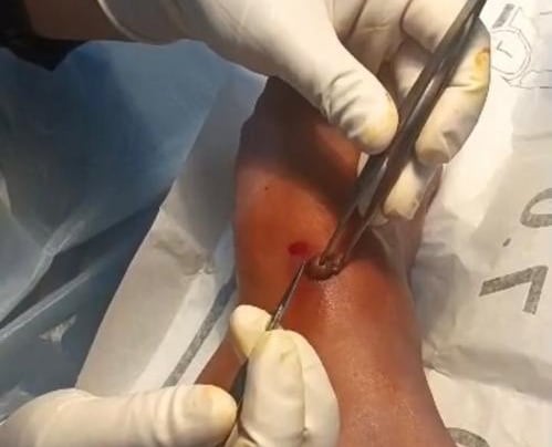 Medical professional performing a minor surgical procedure on a patient's foot using sterile tools.