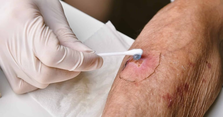 A nurse using a cotton swab to apply ointment to a chronic skin ulcer on an elderly patient's arm.
