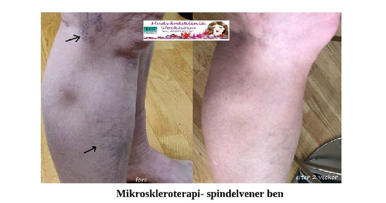 Ben med två ådernätskluster före skleroterapi och 6 veckor efter behandling.