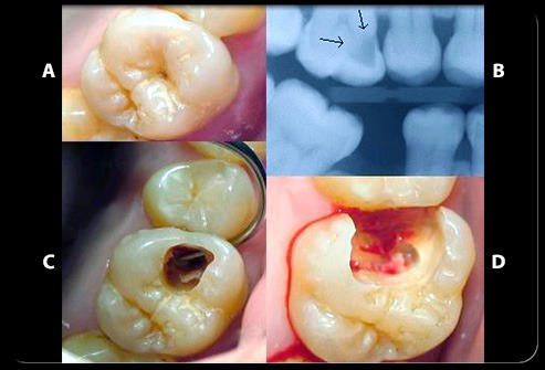 Caries diente