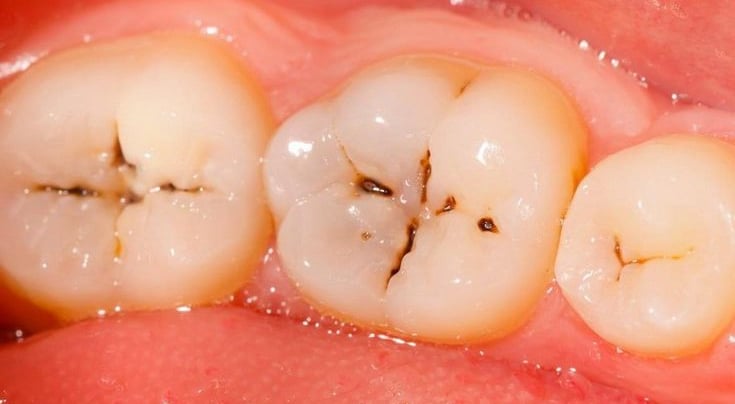 Tambal Gigi Estetik untuk Gigi Berlubang di Malang - Sidharta Dental Studio