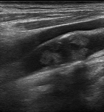 Carotid Duplex plaque