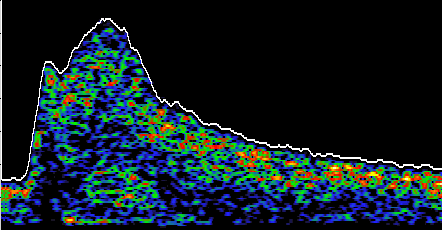 Transcranial Doppler TCD waveform