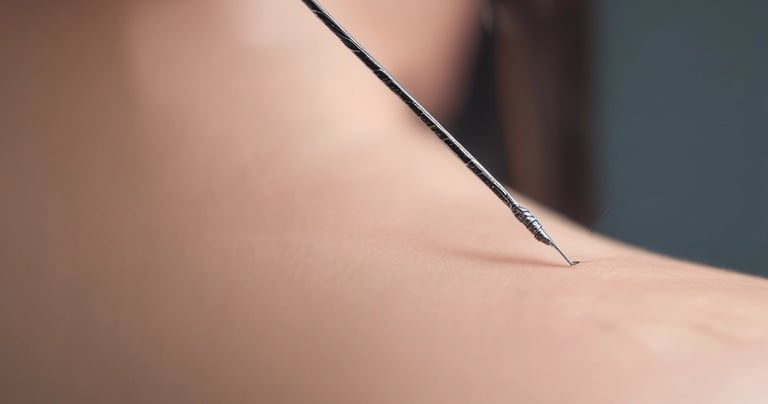 acupuncture