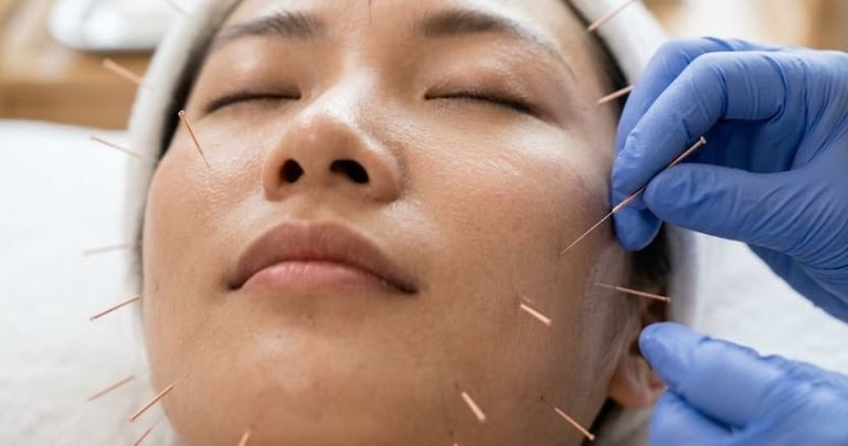 Acupuncture for Cosmetice in Arcadia