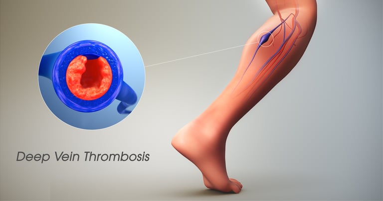 vascular ultrasound blood clot deep vein thrombosis leg swelling thinner anticoagulant embolism pain doppler factor v leiden