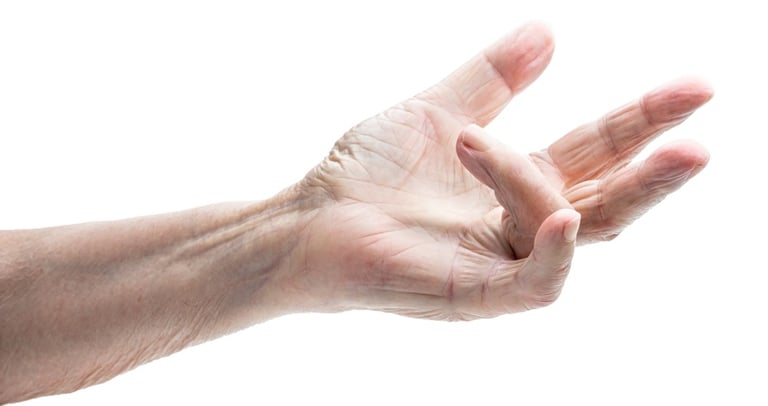 Dupuytrens contracture of the hand and finger