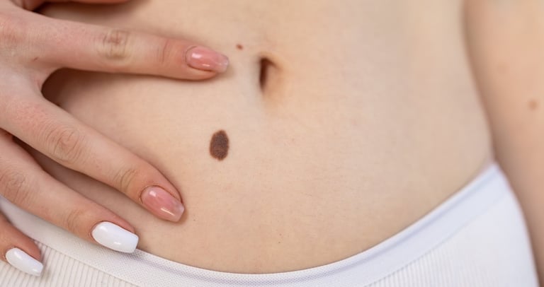 Worried about a mole or mark on the skin?