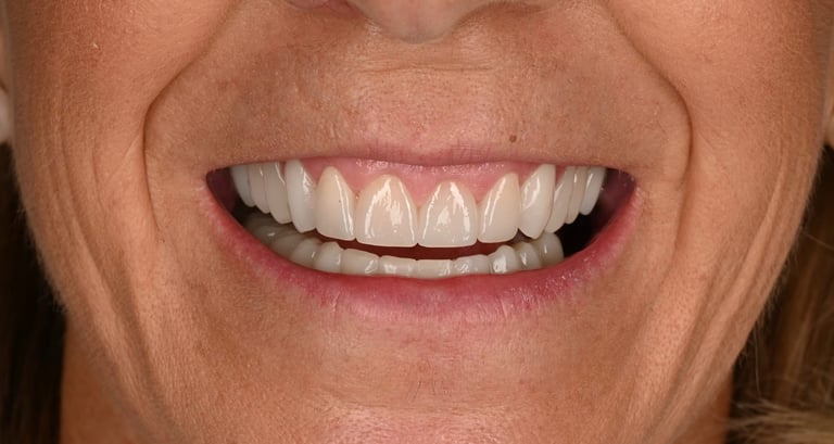 rehabilitación estética superior 14-24 carillas de disilicato de litio y Zr posteriores