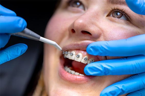 hygiène orthodontie soin jet dentaire ozone Aquolab hygiene-precision.com