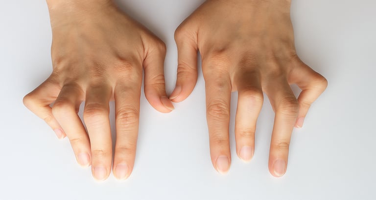   Hands with joint stiffness, deformity on hands and visible inflammation due to RA.