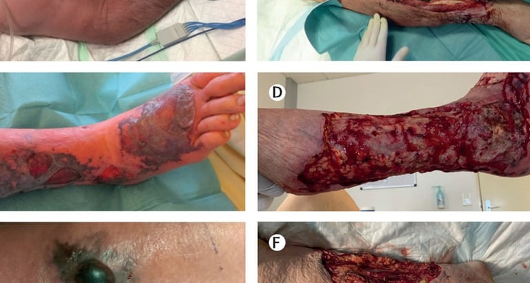 treatment lasts for several weeks