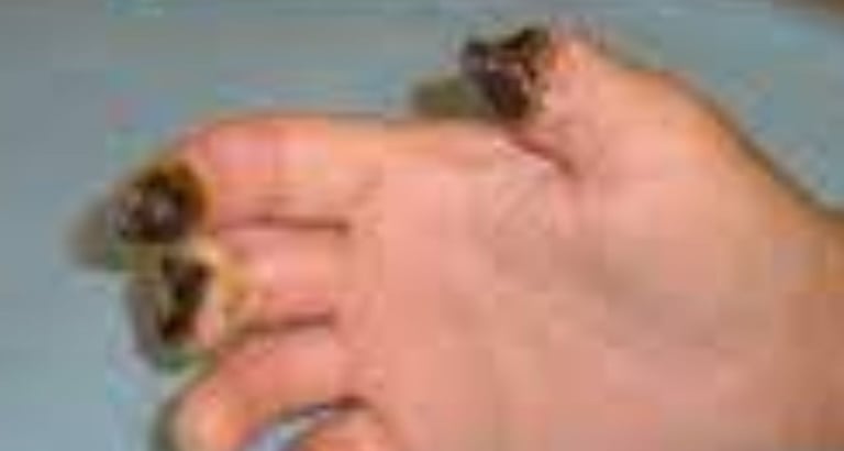 painful digital ulcer