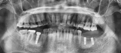 Poza caz pacient implanto 2