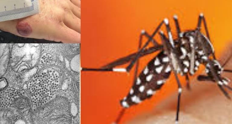 Eastern Equine Encephalitis (EEE)