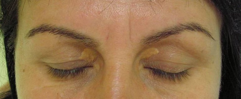 tratament xantelasme depozite colesterol