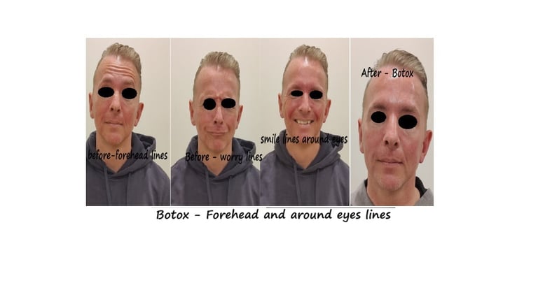 Before and after image of botox in forehead, glabella and around eyes: reduced wrinkles..