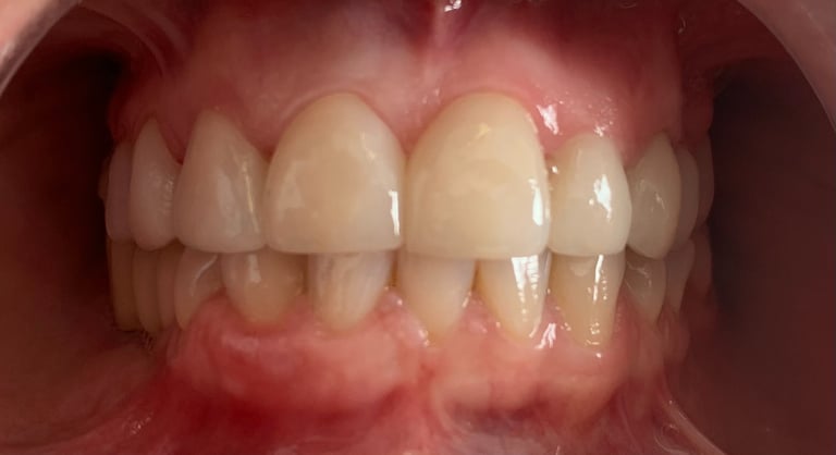 rehabilitación estética carillas 15-25 en disilicato de litio