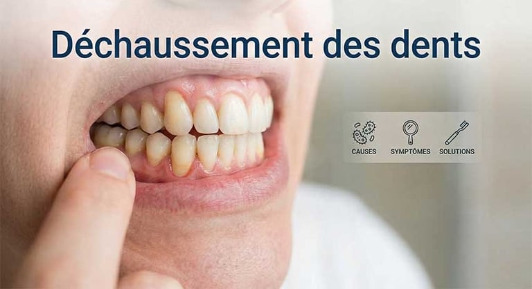 Image de déchaussement des dents