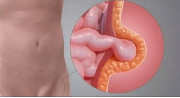 Imagem ilustrativa Hérnia Inguinal