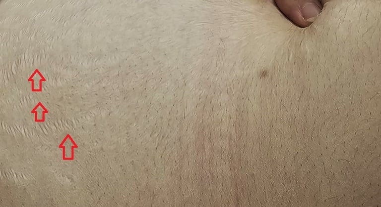 Abdominal stretch marks caused by pregnancy in a woman, before treatment at Ariana Esthetic Edmonton