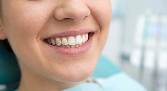 Taches blanches sur les dents hygiene-precision.com