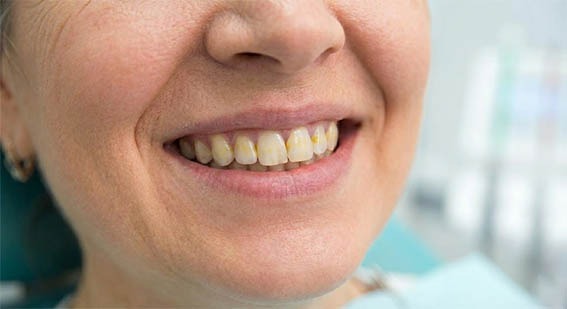 Taches jaune sur les dents hygiene-precision.com