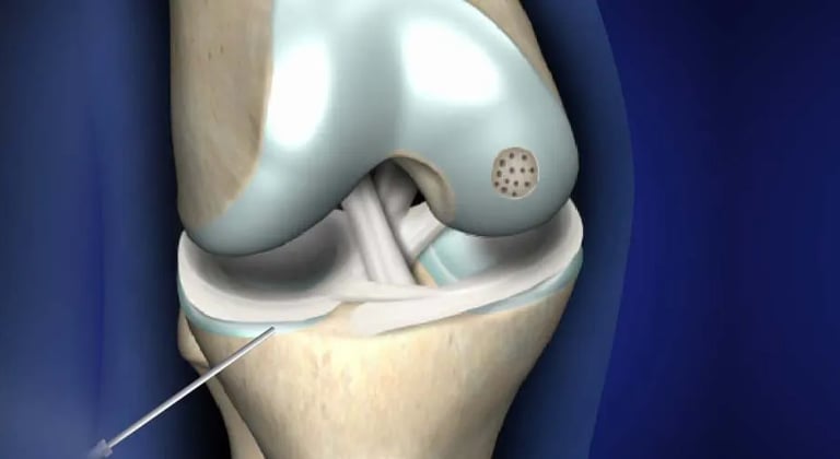 Dr.Rajinikanth's ortho clinic loose bodies