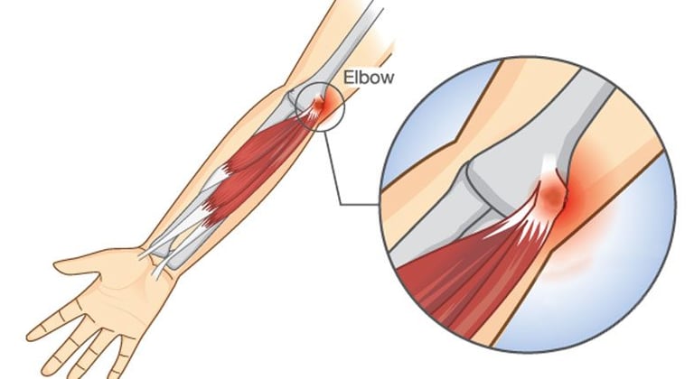 Dr.Rajinikanth's ortho clinic golfers elbow