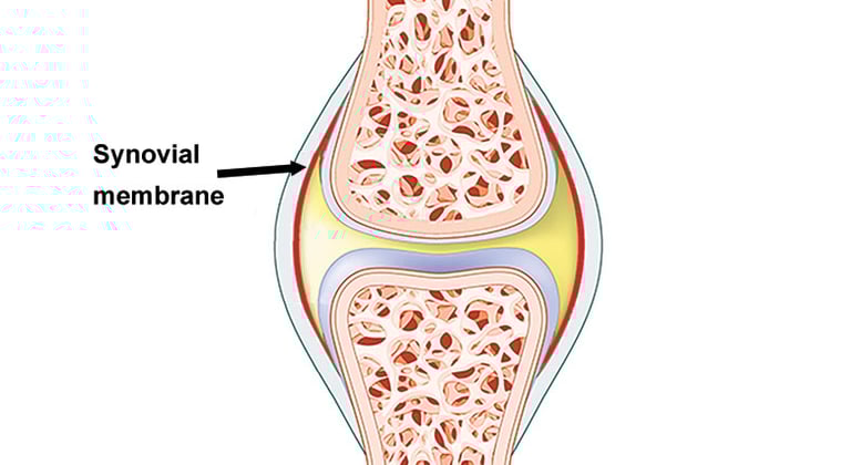 Dr.Rajinikanth's ortho clinic synovitis