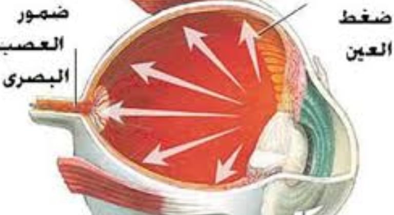 الجلوكوما : خيارات العلاج