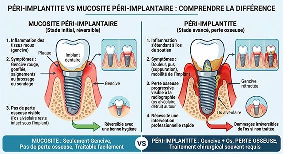 infographie Péri-implantite définition et différence avec la mucosité péri-implantaire