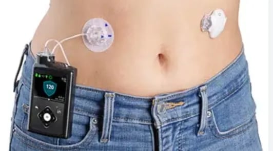 Patient using insulin pump device for diabetes management at Asian Diabetes Center Madinaguda Hyd