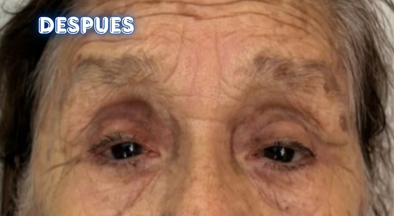 Dra. Lilyan Marissel - Cirugía Plástica y Estética - blefaroplastia-superior-adulto-mayor-cantopexia