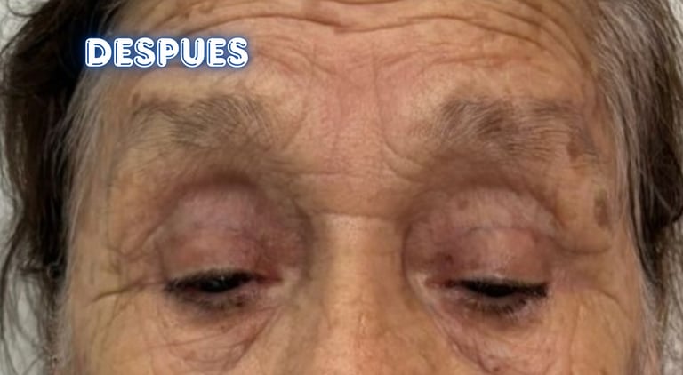 Dra. Lilyan Marissel - Cirugía Plástica y Estética - blefaroplastia-superior-adulto-mayor-cantopexia