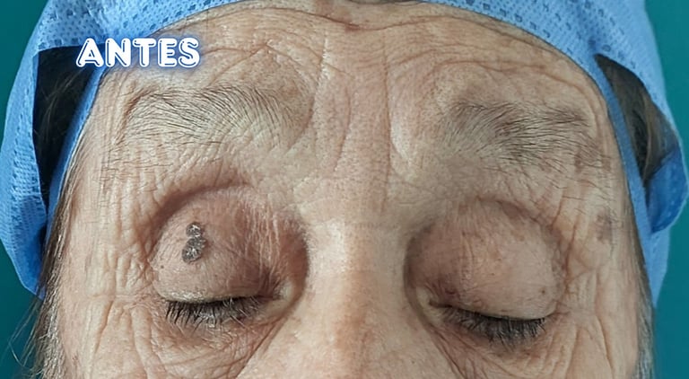 Dra. Lilyan Marissel - Cirugía Plástica y Estética - blefaroplastia-superior-adulto-mayor-cantopexia