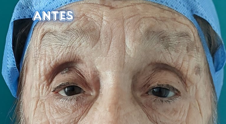 Dra. Lilyan Marissel - Cirugía Plástica y Estética - blefaroplastia-superior-adulto-mayor-cantopexia
