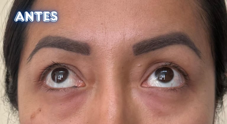 Dra. Lilyan Marissel - Cirugía Plástica y Estética - blefaroplastia-transconjuntival-mujer-bolsas