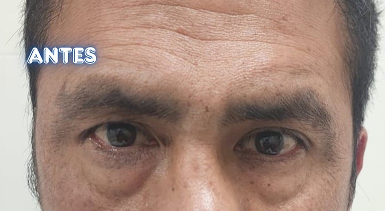 Dra. Lilyan Marissel - Cirugía Plástica y Estética - blefaroplastia-inferior-varon