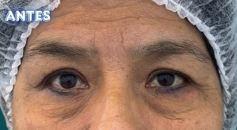 Dra.LilyanMarissel-Cirugía Plástica-Estética - blefaroplastia-mejores-resultados-naturales