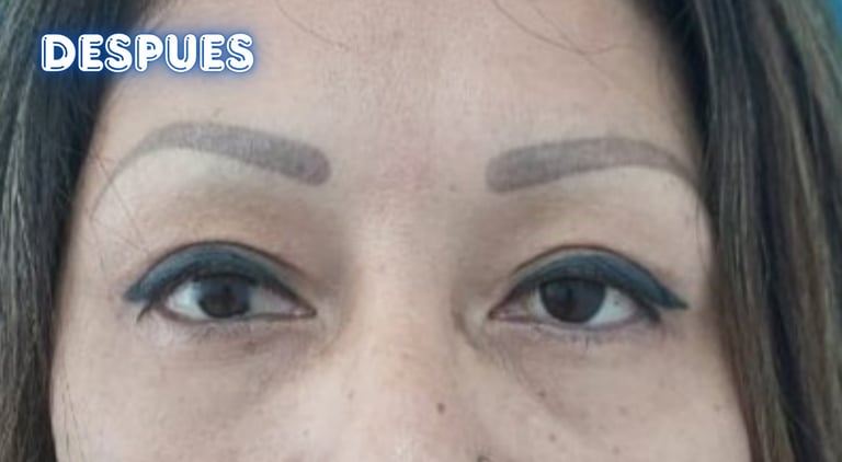 Dra. Lilyan Marissel - Cirugía Plástica y Estética - blefaroplastia-mujer-bolsas