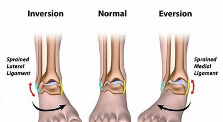 🦶 Achilles Tendon Injury: A Wide-Ranging Overview 🩺 #AchillesTendonInjury #AchillesTear #TendonHe