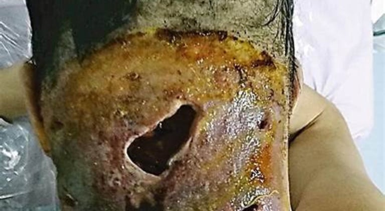 🦠 Flesh-Eating Disease (Necrotizing Fasciitis)