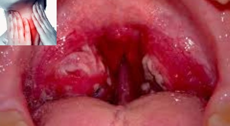 Dr. Hassan Al Warraqi's Approach to Disease Treatments Pharyngitis (Sore Throat)